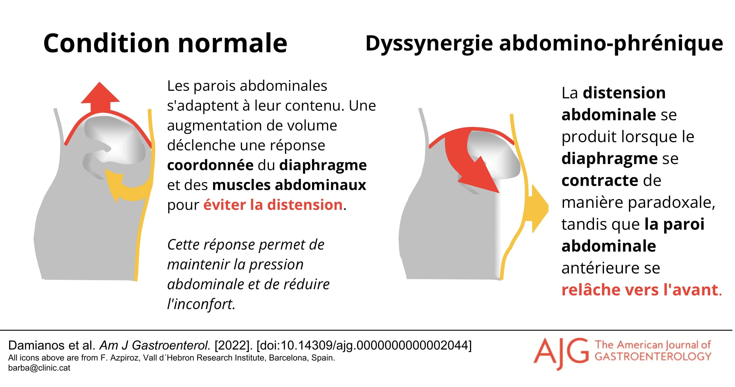 dyssynergie abdomino phrénique