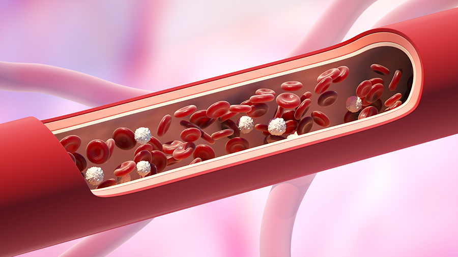 atherosclerosis plaque buildup inside an artery