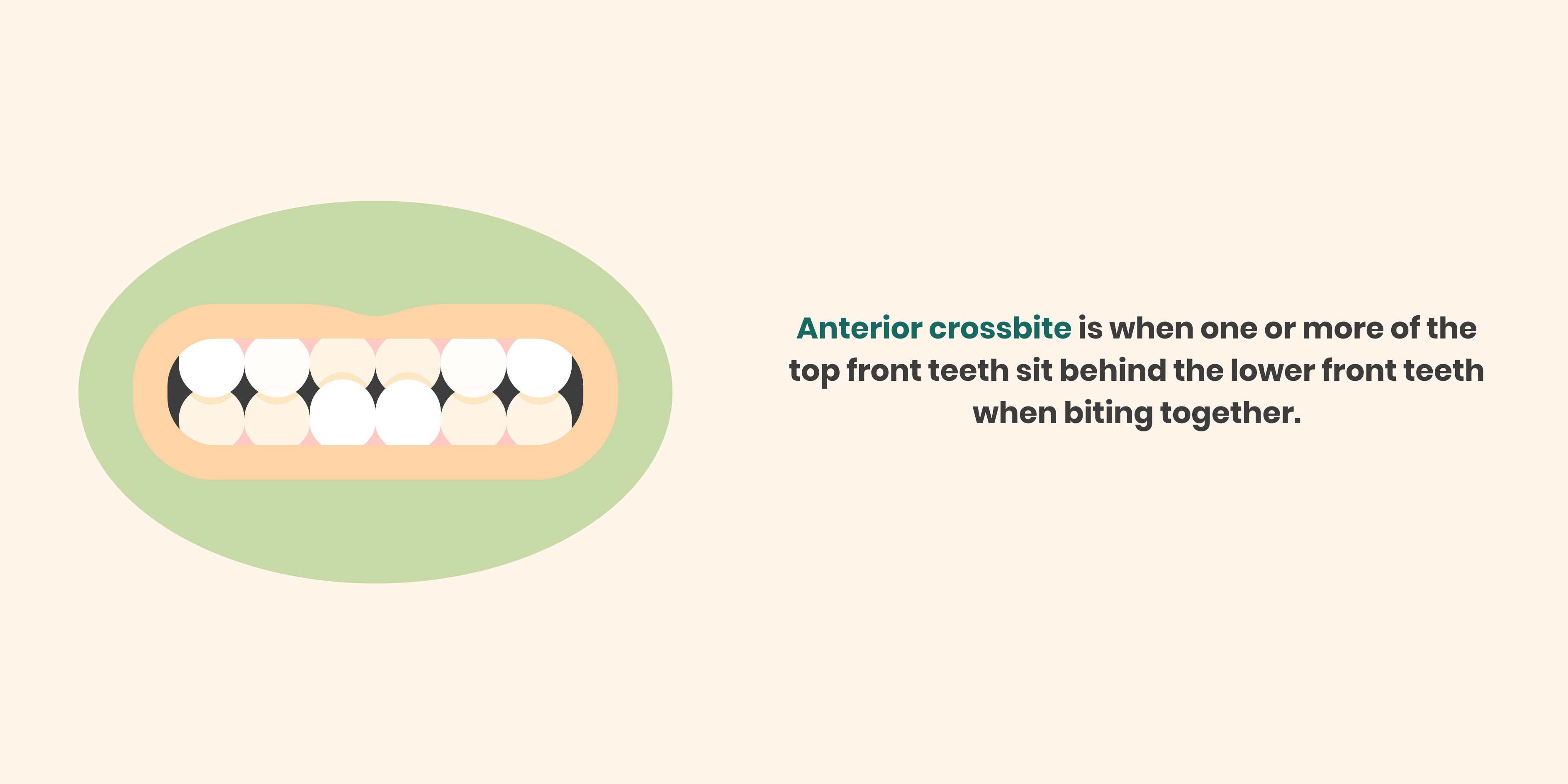 anterior crossbite