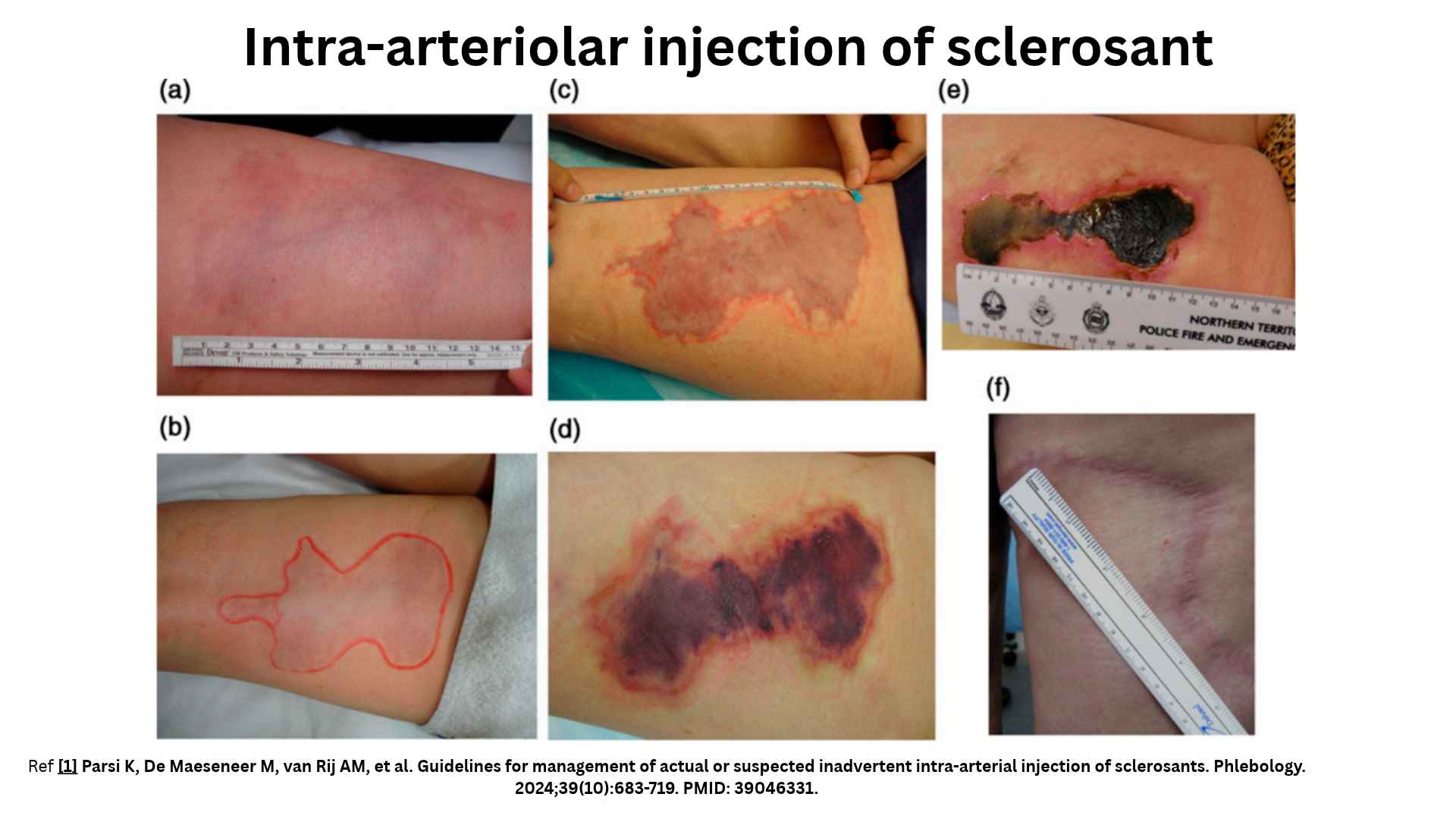 Clinical panel showing the progression of tissue ischemia and cutaneous necrosis following inadvertent intra-arteriolar injection of sclerosant, from early erythema and demarcated livedo to full-thickness eschar and eventual scarring (Parsi et al., 2024).