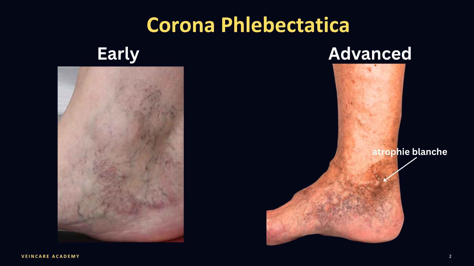 Image showing early ankle flare and advanced corona phlebectatica. 