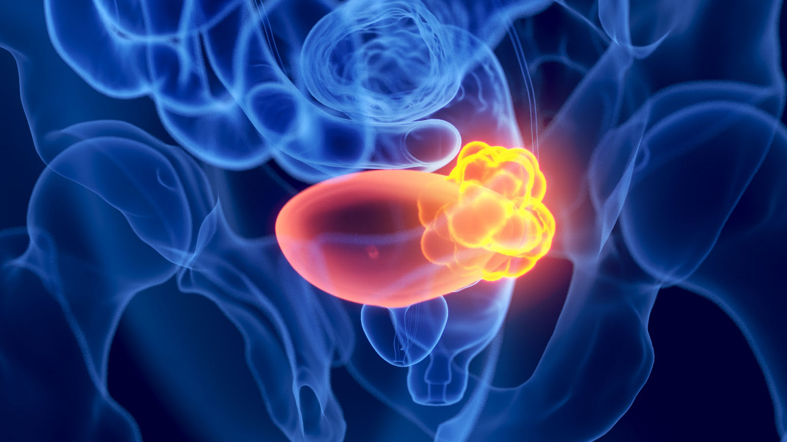 Cette illustration médicale en 3D, précise et très détaillée, présente une vue latérale en gros plan d'un cancer de la vessie sur une radiographie. Sur un fond noir uni