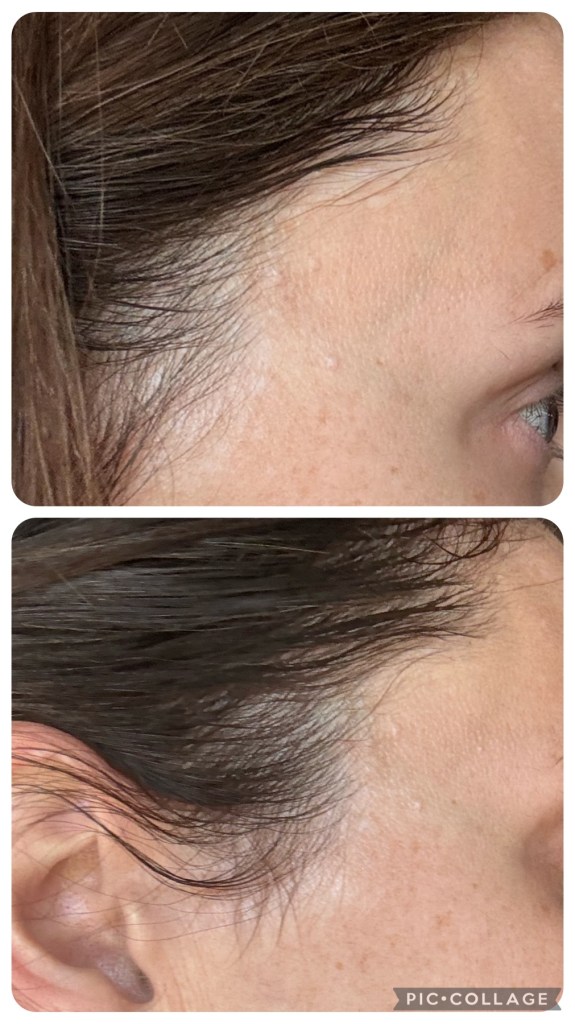 before and after of hair loss due to increased hormonal fluxuations and stress 