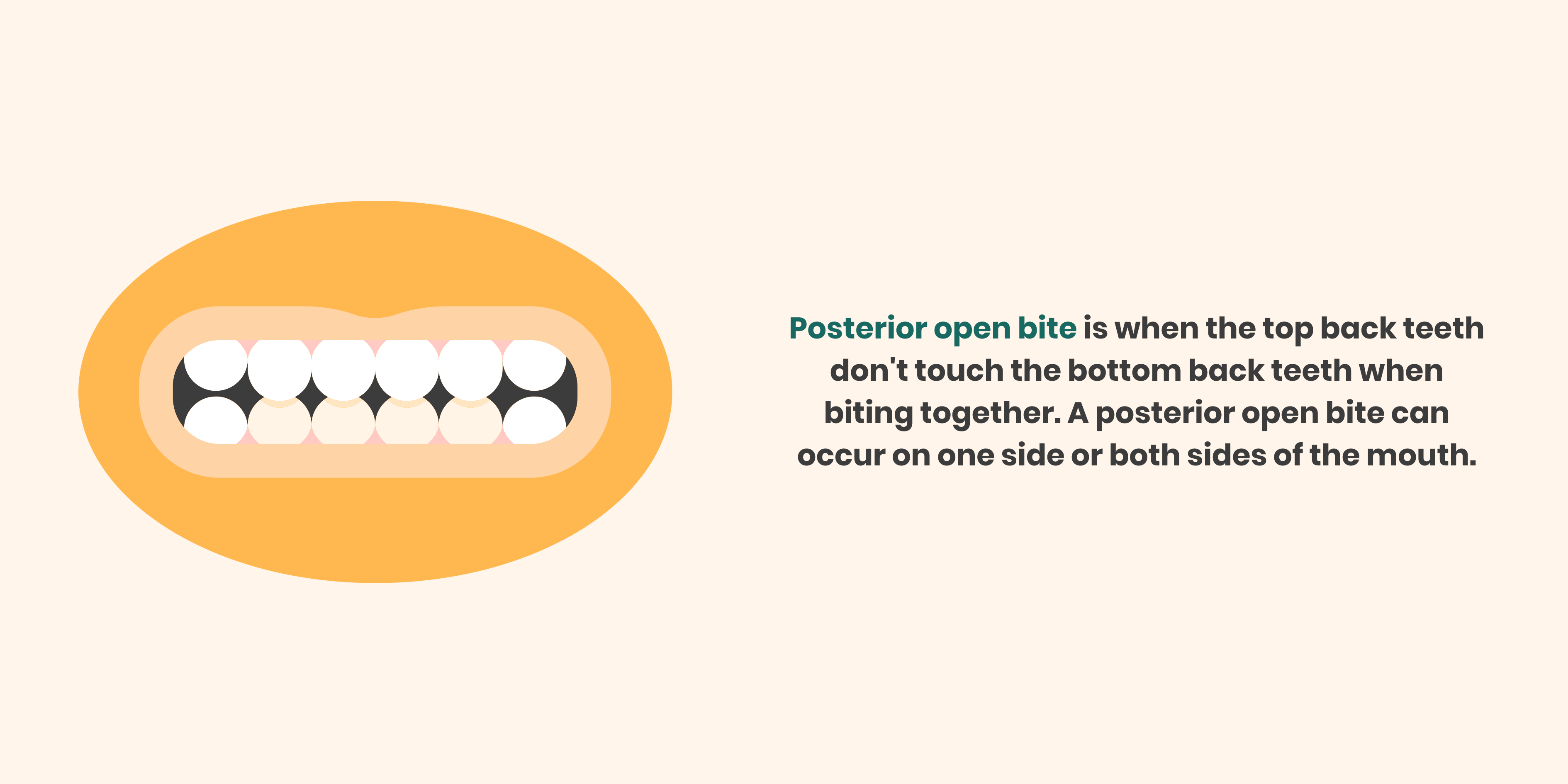 posterior open bite