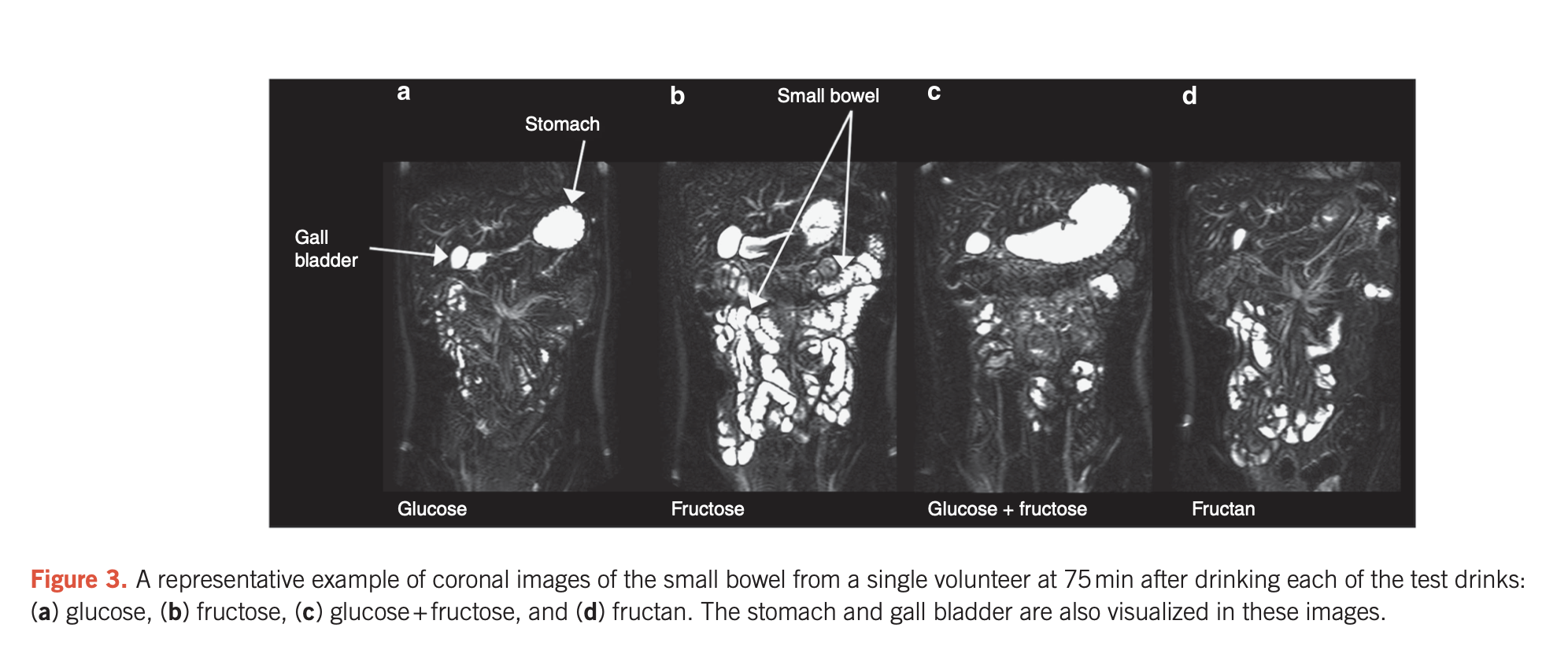 IRM fructose FODMAP eau