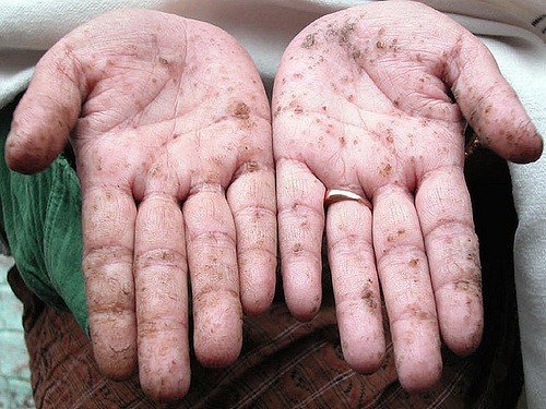 Hands with palms up showing the signs of arsenic poisoning.