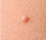 Linfogranuloma venéreo