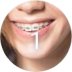 Brackets metálicos