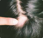 Alopecias cicatriciales