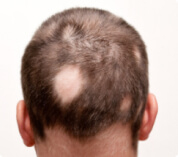 Alopecias difusas o no cicatriciales