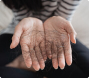 Alopecia traumática