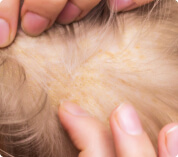 Dermatitis seborreica