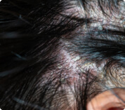 Psoriasis del cuero cabelludo