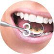 Brackets linguales