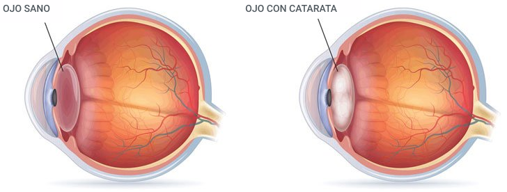 ¿Qué son las cataratas en los ojos?