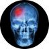 Accidente cerebrovascular