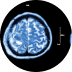 Anomalías cerebrales