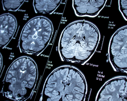 ¿Qué es la epilepsia?