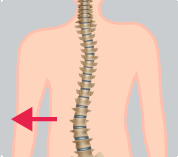 Levoescoliosis