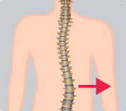 Dextroescoliosis