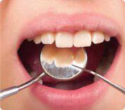 Placa dental y sarro en los dientes