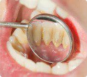 Placa acumulada en los dientes