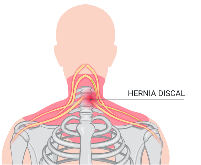 Hernia discal cervical