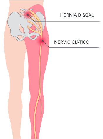 Hernia discal lumbar