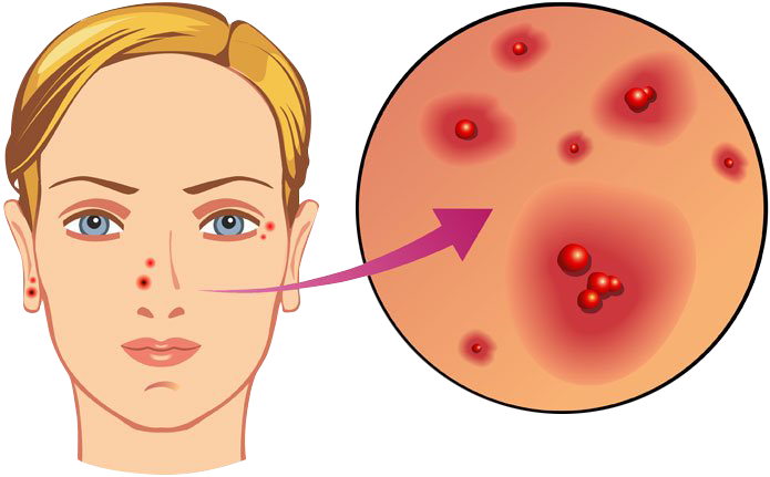 Herpes en oído, ojo y nariz