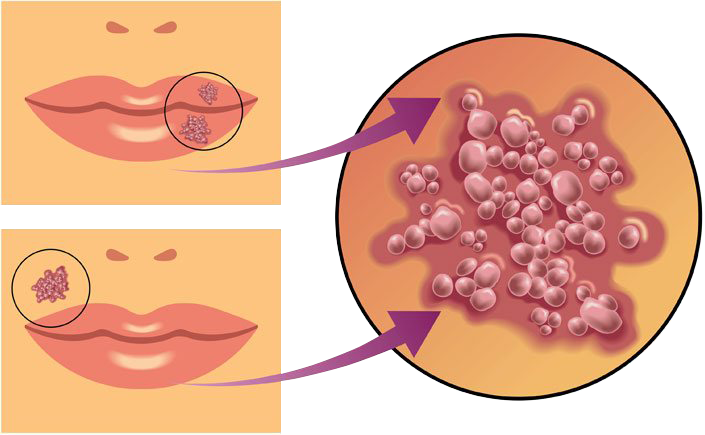 Herpes labial