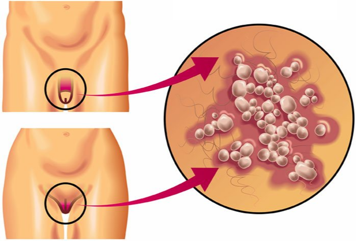 Herpes genital