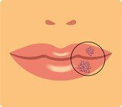 Tipos de herpes