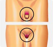 Tipos de herpes