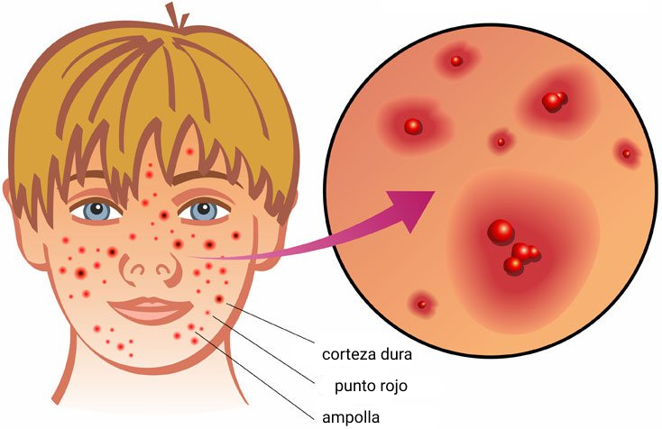 Herpes zoster