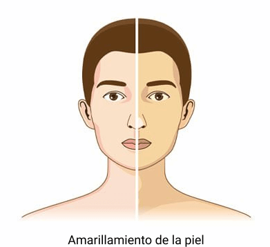 ictericia piel