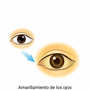 ictericia ojos