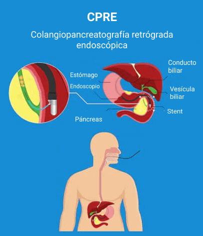 Ιctericia pancreatitis