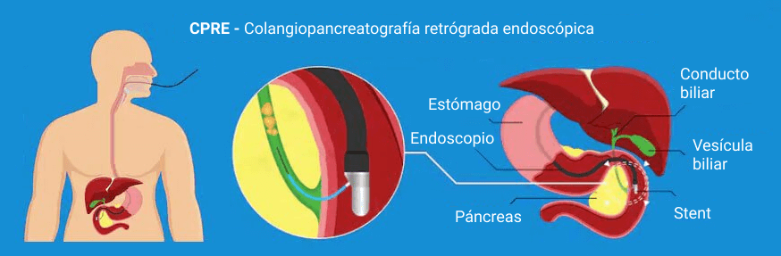 Ιctericia pancreatitis