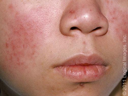 Lupus eritematoso cutaneo agudo