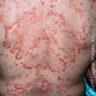 Lupus eritematoso subcutáneo