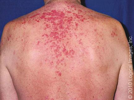Lupus eritematoso subcutáneo