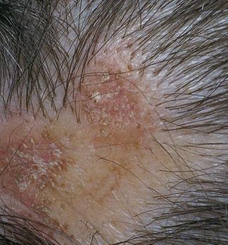 Lupus eritematoso crónico