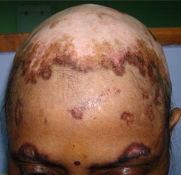 Lupus eritematoso crónico