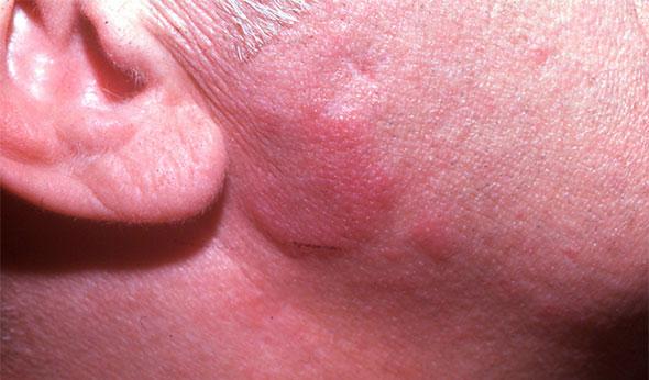 Lupus cutaneo crónico hipertrófico