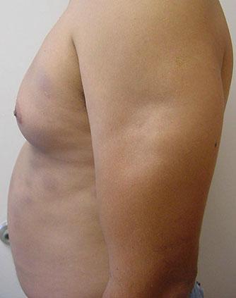 Lupus eritematoso cutáneo crónico subcutáneo