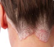 Psoriasis vulgar o psoriasis en placas