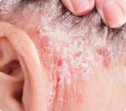Psoriasis inversa