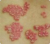 Psoriasis pustulosa