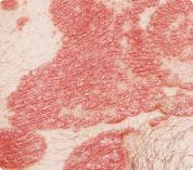 Psoriasis eritrodérmica