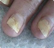 Psoriasis en las uñas